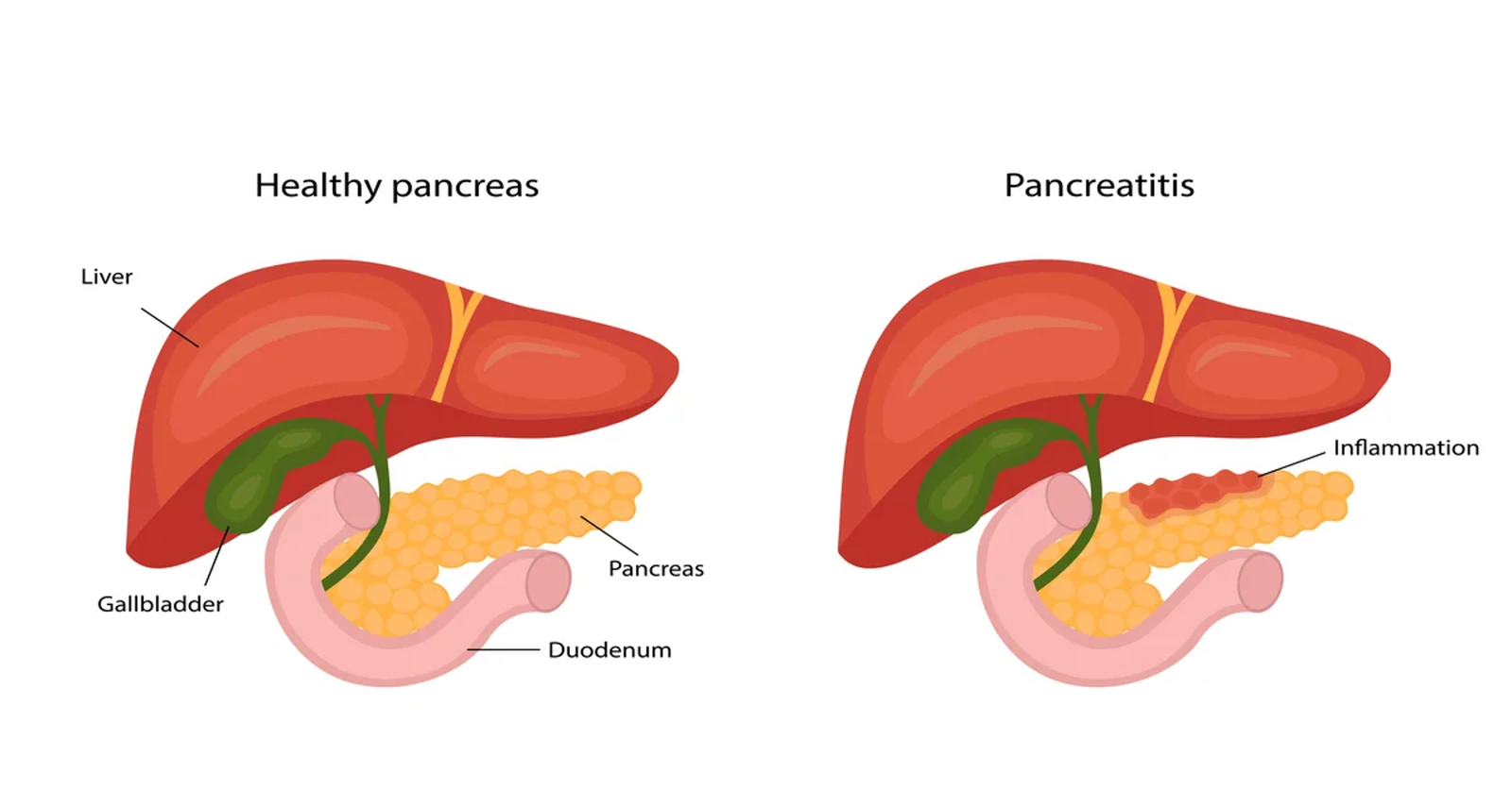 Pancreatitis Management
